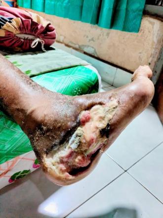 Diabetes, Si Pembunuh Senyap : Ancaman Nyata di Tengah Masyarakat
